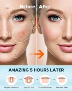 36 pcs Acne Patch Pimple Patch Beauty Products - Image 2